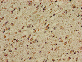 Immunohistochemistry of paraffin-embedded human glioma using CPT1C Antibody at dilution of 1:100Rabbit anti-Human CPT1C Polyclonal Antibody
