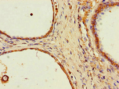 Immunohistochemistry of paraffin-embedded human prostate cancer using the antibody at dilution of 1:100Rabbit anti-Human SPPL2A Polyclonal Antibody