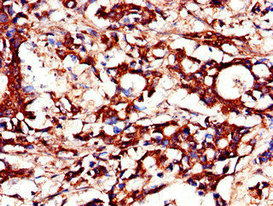 Immunohistochemistry of paraffin-embedded human gastric cancer using the antibody at dilution of 1:100Rabbit anti-Human DUSP19 Polyclonal Antibody