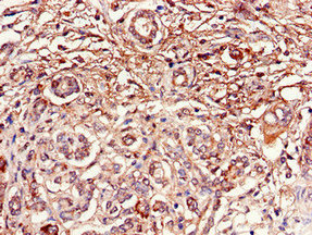 Immunohistochemistry of paraffin-embedded human pancreatic cancer using DUSP19 Antibody at dilution of 1:100Rabbit anti-Human DUSP19 Polyclonal Antibody
