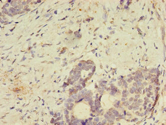 Immunohistochemistry of paraffin-embedded human gastric cancer using SPIRE2 Antibody at dilution of 1:100Rabbit anti-Human SPIRE2 Polyclonal Antibody