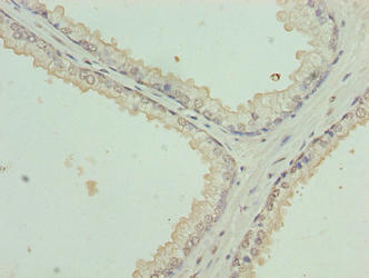 Immunohistochemistry of paraffin-embedded human prostate cancer using KRT35 Antibody at dilution of 1:100