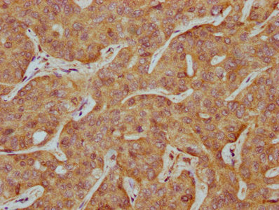 IHC image of SLCO2A1 Antibody diluted at 1:500 and staining in paraffin-embedded human liver cancer performed on a Leica BondTM system. After dewaxing and hydration, antigen retrieval was mediated by high pressure in a citrate buffer (pH 6.0). Section was blocked with 10% normal goat serum 30min at RT. Then primary antibody (1% BSA) was incubated at 4°C overnight. The primary is detected by a biotinylated secondary antibody and visualized using an HRP conjugated SP system.Rabbit anti-Human SLCO2A1 Polyclonal Antibody