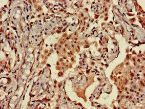 Immunohistochemistry of paraffin-embedded human lung cancer using NINJ1 Antibody at dilution of 1:100Rabbit anti-Human NINJ1 Polyclonal Antibody