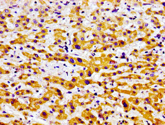 Immunohistochemistry of paraffin-embedded human liver cancer using USP9X Antibody at dilution of 1:100Rabbit anti-Human USP9X Polyclonal Antibody