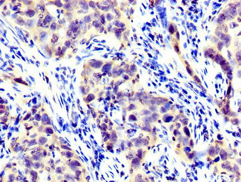IHC image of LPP Antibody diluted at 1:300 and staining in paraffin-embedded human pancreatic cancer performed on a Leica BondTM system. After dewaxing and hydration, antigen retrieval was mediated by high pressure in a citrate buffer (pH 6.0). Section was blocked with 10% normal goat serum 30min at RT. Then primary antibody (1% BSA) was incubated at 4°C overnight. The primary is detected by a biotinylated secondary antibody and visualized using an HRP conjugated SP system.