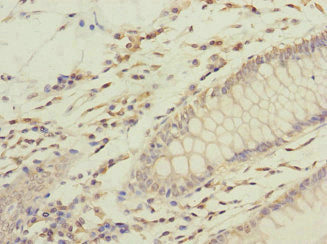 Immunohistochemistry of paraffin-embedded human colon cancer using GFM2 Antibody at dilution of 1:100Rabbit anti-Human GFM2 Polyclonal Antibody