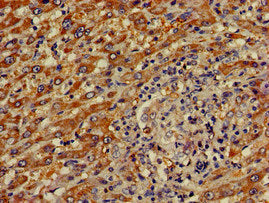 Immunohistochemistry of paraffin-embedded human liver cancer using the antibody at dilution of 1:100Rabbit anti-Human CREB3L1 Polyclonal Antibody