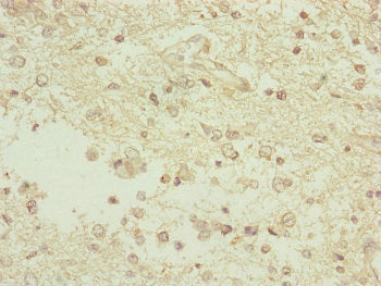 Immunohistochemistry of paraffin-embedded human glioma using TAMM41 Antibody at dilution of 1:100Rabbit anti-Human TAMM41 Polyclonal Antibody