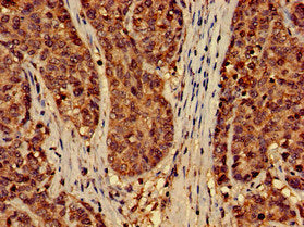 Immunohistochemistry of paraffin-embedded human ovarian cancer using the antibody at dilution of 1:100Rabbit anti-Human EFHD2 Polyclonal Antibody
