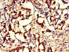 Immunohistochemistry of paraffin-embedded human gastric cancer using GNPNAT1 Antibody at dilution of 1:100Rabbit anti-Human GNPNAT1 Polyclonal Antibody