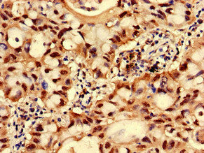 Immunohistochemistry of paraffin-embedded human lung cancer using GNPNAT1 Antibody at dilution of 1:100Rabbit anti-Human GNPNAT1 Polyclonal Antibody