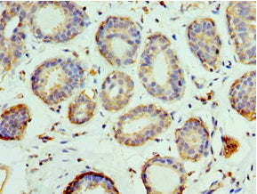 Immunohistochemistry of paraffin-embedded human breast cancer using PELI1 Antibody at dilution of 1:100Rabbit anti-Human PELI1 Polyclonal Antibody