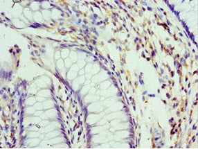 Immunohistochemistry of paraffin-embedded human colon cancer using PELI1 Antibody at dilution of 1:100Rabbit anti-Human PELI1 Polyclonal Antibody