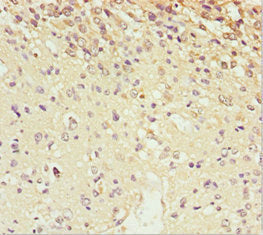 Immunohistochemistry of paraffin-embedded human glioma using SCRN2 Antibody at dilution of 1:100Rabbit anti-Human SCRN2 Polyclonal Antibody