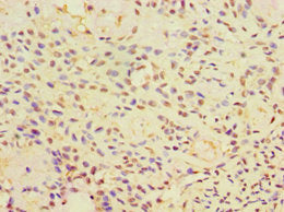 Immunohistochemistry of paraffin-embedded human breast cancer using CALR3 Antibody at dilution of 1:100