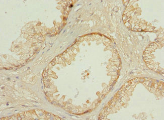 Immunohistochemistry of paraffin-embedded human prostate cancer using PPP3R2 Antibody at dilution of 1:100Rabbit anti-Human PPP3R2 Polyclonal Antibody