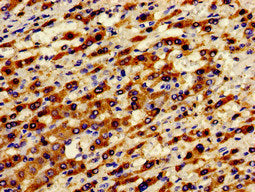 Immunohistochemistry of paraffin-embedded human liver cancer using ADGRA2 Antibody at dilution of 1:100Rabbit anti-Human ADGRA2 Polyclonal Antibody