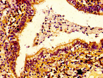 IHC image of ERGIC2 Antibody diluted at 1:100 and staining in paraffin-embedded human lung cancer performed on a Leica BondTM system. After dewaxing and hydration, antigen retrieval was mediated by high pressure in a citrate buffer (pH 6.0). Section was blocked with 10% normal goat serum 30min at RT. Then primary antibody (1% BSA) was incubated at 4°C overnight. The primary is detected by a biotinylated secondary antibody and visualized using an HRP conjugated SP system.Rabbit anti-Human ERGIC2 Polyclonal Antibody