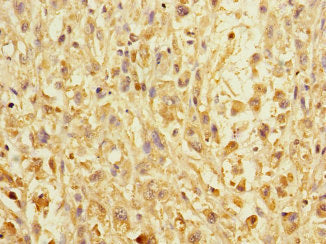 Immunohistochemistry of paraffin-embedded human melanoma using ERBIN Antibody at dilution of 1:100Rabbit anti-Human ERBIN Polyclonal Antibody