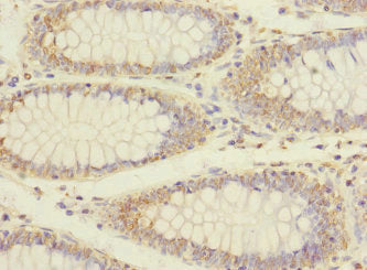 Immunohistochemistry of paraffin-embedded human colon cancer using ERBIN Antibody at dilution of 1:100Rabbit anti-Human ERBIN Polyclonal Antibody