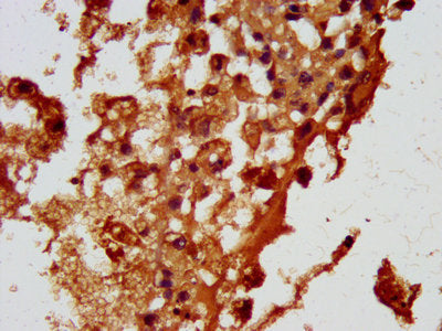 IHC image of the antibody diluted at 1:100 and staining in paraffin-embedded human melanoma performed on a Leica BondTM system. After dewaxing and hydration, antigen retrieval was mediated by high pressure in a citrate buffer (pH 6.0). Section was blocked with 10% normal goat serum 30min at RT. Then primary antibody (1% BSA) was incubated at 4°C overnight. The primary is detected by a biotinylated secondary antibody and visualized using an HRP conjugated SP system.Rabbit anti-Human HBEGF Polyclonal Antibody