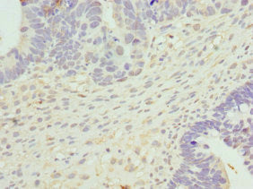 Immunohistochemistry of paraffin-embedded human ovarian cancer using CYTH2 Antibody at dilution of 1:100Rabbit anti-Human CYTH2 Polyclonal Antibody