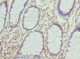 Immunohistochemistry of paraffin-embedded human colon cancer using CYTH2 Antibody at dilution of 1:100Rabbit anti-Human CYTH2 Polyclonal Antibody