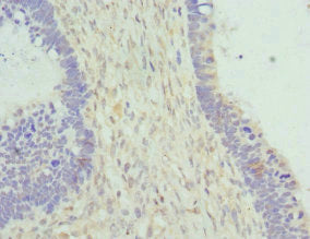 Immunohistochemistry of paraffin-embedded human ovarian cancer using CYTH2 Antibody at dilution of 1:100