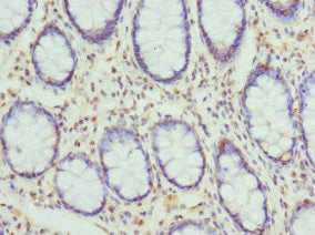 Immunohistochemistry of paraffin-embedded human colon cancer using CYTH2 Antibody at dilution of 1:100