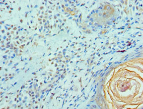 Immunohistochemistry of paraffin-embedded human breast cancer using the antibody at dilution of 1:100Rabbit anti-Human ELF4 Polyclonal Antibody