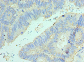 Immunohistochemistry of paraffin-embedded human colon cancer using ELF4 Antibody at dilution of 1:100Rabbit anti-Human ELF4 Polyclonal Antibody