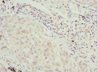 Immunohistochemistry of paraffin-embedded human lung cancer using VRK1 Antibody at dilution of 1:100Rabbit anti-Human VRK1 Polyclonal Antibody