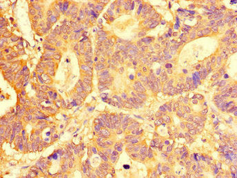 Immunohistochemistry of paraffin-embedded human colon cancer using SLC29A1 Antibody at dilution of 1:100Rabbit anti-Human SLC29A1 Polyclonal Antibody