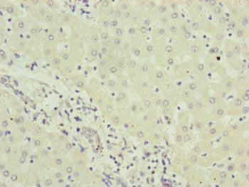 Immunohistochemistry of paraffin-embedded human liver cancer using RNF5 Antibody at dilution of 1:100Rabbit anti-Human RNF5 Polyclonal Antibody