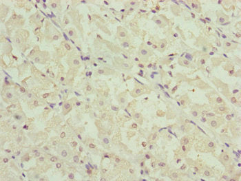 Immunohistochemistry of paraffin-embedded human gastric cancer using RNF5 Antibody at dilution of 1:100Rabbit anti-Human RNF5 Polyclonal Antibody