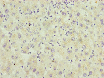 Immunohistochemistry of paraffin-embedded human liver cancer using RNF5 Antibody at dilution of 1:100Rabbit anti-Human RNF5 Polyclonal Antibody