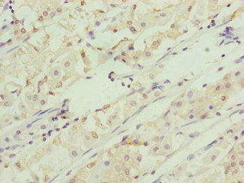 Immunohistochemistry of paraffin-embedded human gastric cancer using RNF5 Antibody at dilution of 1:100Rabbit anti-Human RNF5 Polyclonal Antibody