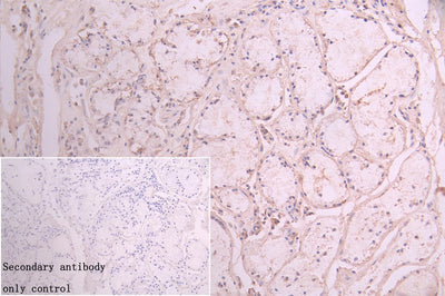 Immunohistochemistry of paraffin-embedded human lung cancer using the antibody at dilution of 1:100