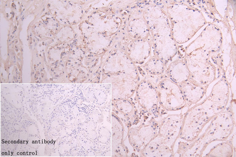 Immunohistochemistry of paraffin-embedded human lung cancer using the antibody at dilution of 1:100