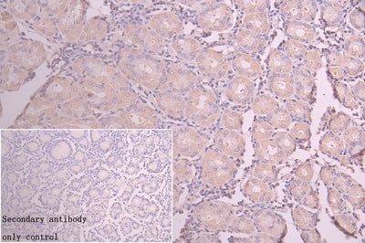 Immunohistochemistry of paraffin-embedded human colon cancer using AKAP9 Antibody at dilution of 1:100