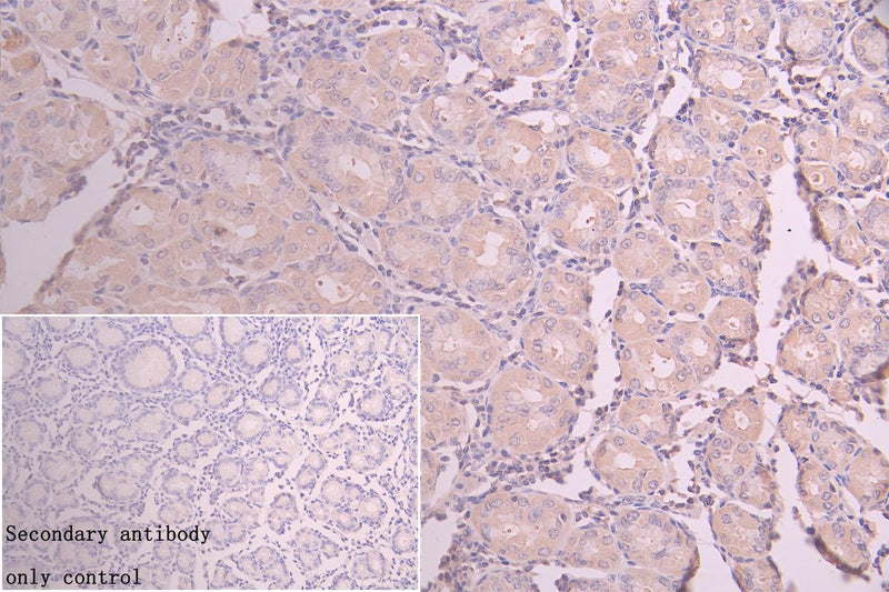 Immunohistochemistry of paraffin-embedded human colon cancer using AKAP9 Antibody at dilution of 1:100