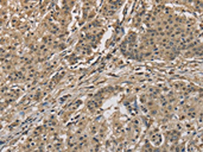 The image is immunohistochemistry of paraffin-embedded Human gastric cancer tissue using CYCS Antibody(CYCS Antibody) at dilution 1/70. (Original magnification: ×200)Rabbit anti-Human CYCS Polyclonal Antibody