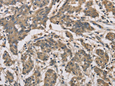 The image is immunohistochemistry of paraffin-embedded Human colon cancer tissue using the antibody Antibody) at dilution 1/70. (Original magnification: ×200)Rabbit anti-Human CYCS Polyclonal Antibody