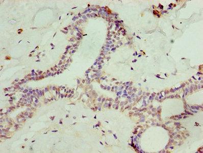 Immunohistochemistry of paraffin-embedded human breast cancer using SOST Antibody at dilution of 1:100Rabbit anti-Human SOST Polyclonal Antibody