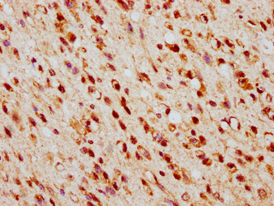 IHC image of TSNAX Antibody diluted at 1:500 and staining in paraffin-embedded human glioma performed on a Leica BondTM system. After dewaxing and hydration, antigen retrieval was mediated by high pressure in a citrate buffer (pH 6.0). Section was blocked with 10% normal goat serum 30min at RT. Then primary antibody (1% BSA) was incubated at 4°C overnight. The primary is detected by a biotinylated secondary antibody and visualized using an HRP conjugated SP system.Rabbit anti-Human TSNAX Polyclonal Antibody