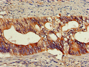 Immunohistochemistry of paraffin-embedded human colon cancer using OLFM1 Antibody at dilution of 1:100Rabbit anti-Human OLFM1 Polyclonal Antibody