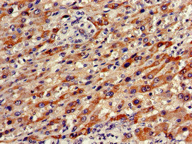 Immunohistochemistry of paraffin-embedded human liver cancer using OLFM1 Antibody at dilution of 1:100Rabbit anti-Human OLFM1 Polyclonal Antibody