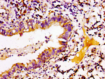 IHC image of ARID3A Antibody diluted at 1:100 and staining in paraffin-embedded human lung cancer performed on a Leica BondTM system. After dewaxing and hydration, antigen retrieval was mediated by high pressure in a citrate buffer (pH 6.0). Section was blocked with 10% normal goat serum 30min at RT. Then primary antibody (1% BSA) was incubated at 4°C overnight. The primary is detected by a biotinylated secondary antibody and visualized using an HRP conjugated SP system.Rabbit anti-Human ARID3A Polyclonal Antibody