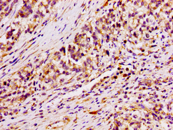 IHC image of ARID3A Antibody diluted at 1:100 and staining in paraffin-embedded human colon cancer performed on a Leica BondTM system. After dewaxing and hydration, antigen retrieval was mediated by high pressure in a citrate buffer (pH 6.0). Section was blocked with 10% normal goat serum 30min at RT. Then primary antibody (1% BSA) was incubated at 4°C overnight. The primary is detected by a biotinylated secondary antibody and visualized using an HRP conjugated SP system.Rabbit anti-Human ARID3A Polyclonal Antibody